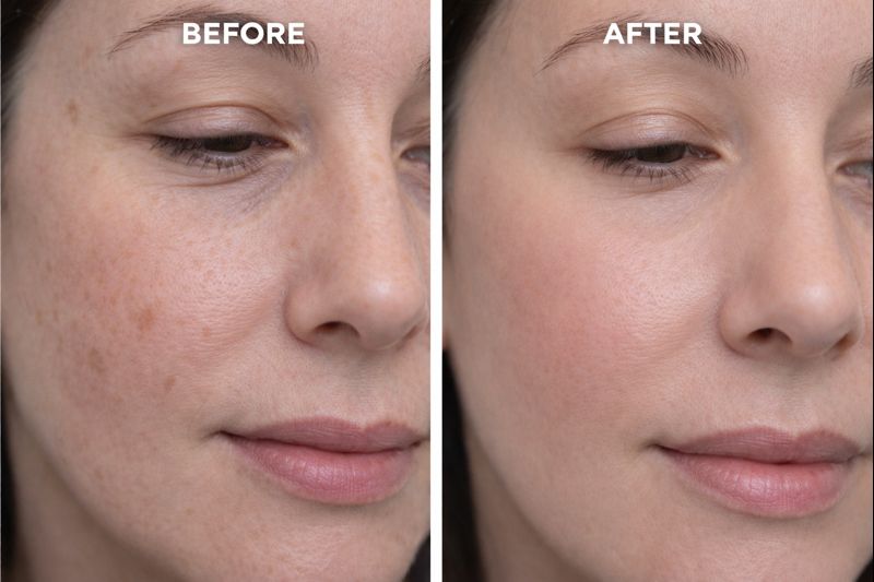 PRP facial rejuvenation before and after