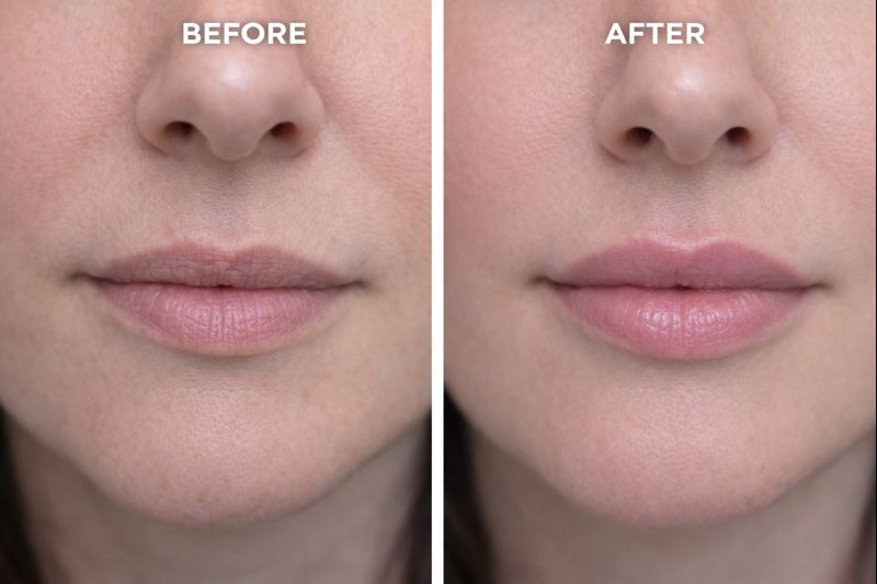 PRP lip rejuvenation before and after