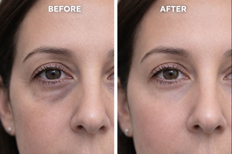 PRP under-eye before and after